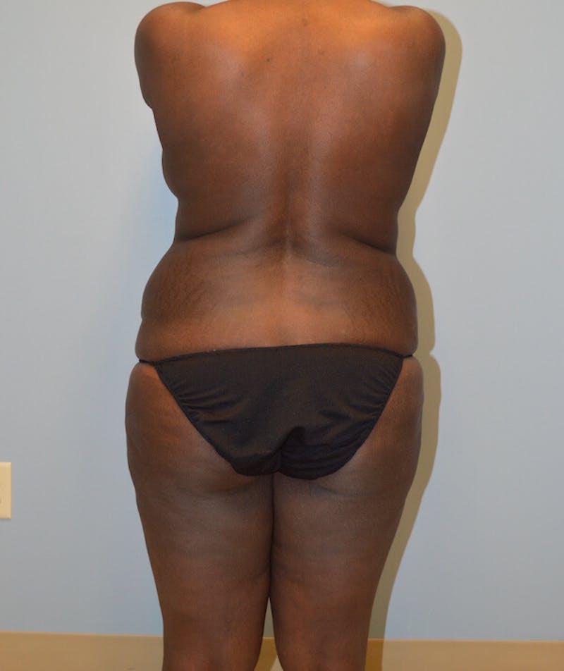 High Definition Mommy Makeover Before & After Gallery - Patient 294898 - Image 5