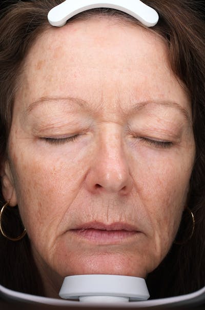 Lasers & Light Before & After Gallery - Patient 223178 - Image 1
