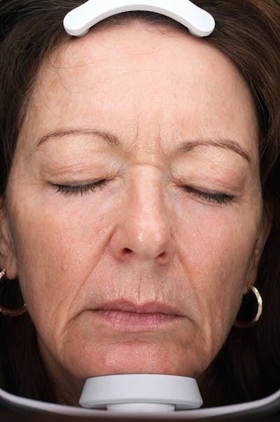 Lasers & Light Before & After Gallery - Patient 223178 - Image 2