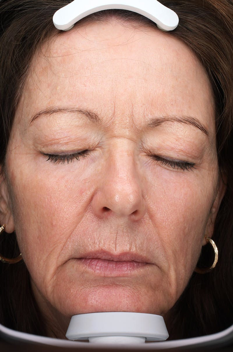 Lasers & Light Before & After Gallery - Patient 223178 - Image 2
