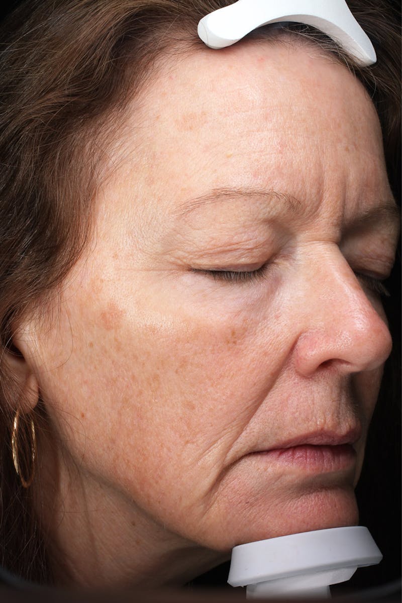 Lasers & Light Before & After Gallery - Patient 223178 - Image 3