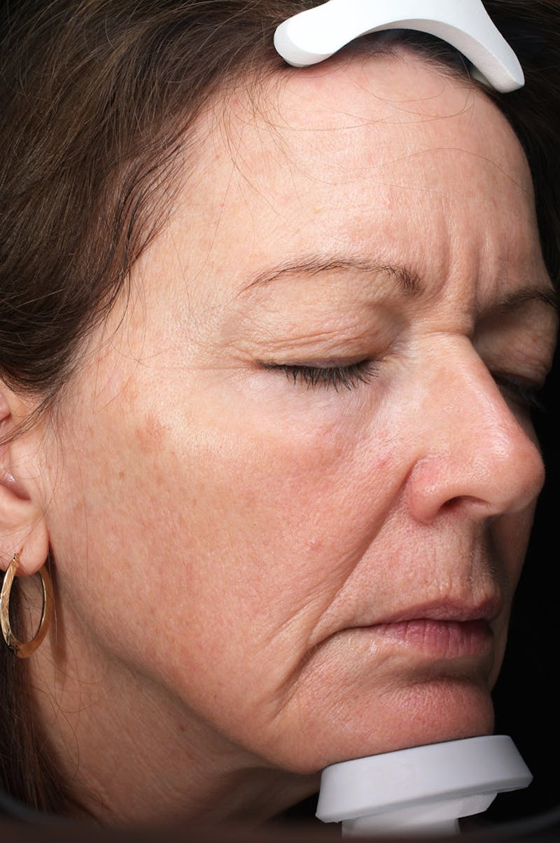 Lasers & Light Before & After Gallery - Patient 223178 - Image 4