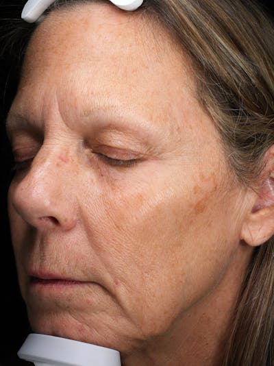 Lasers & Light Before & After Gallery - Patient 381529 - Image 1