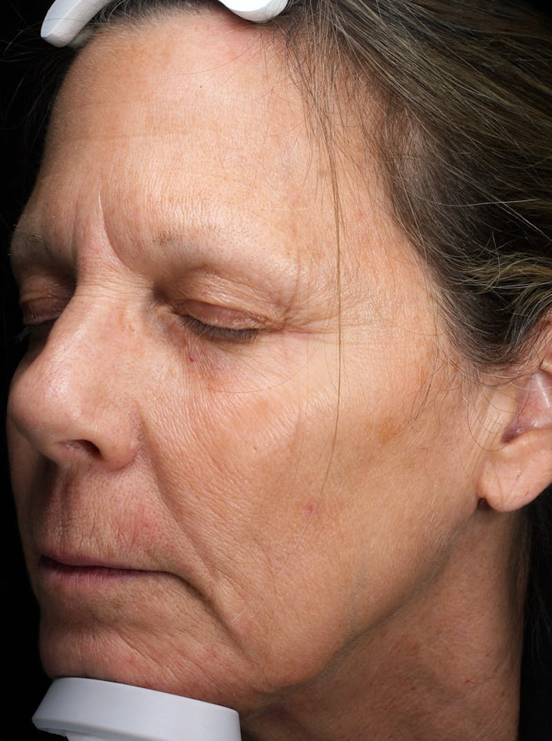 Lasers & Light Before & After Gallery - Patient 381529 - Image 2