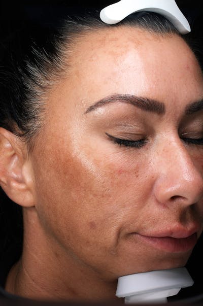 Lasers & Light Before & After Gallery - Patient 343468 - Image 1