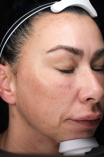 Lasers & Light Before & After Gallery - Patient 343468 - Image 2