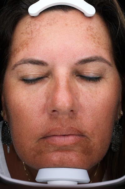 Lasers & Light Before & After Gallery - Patient 363004 - Image 1
