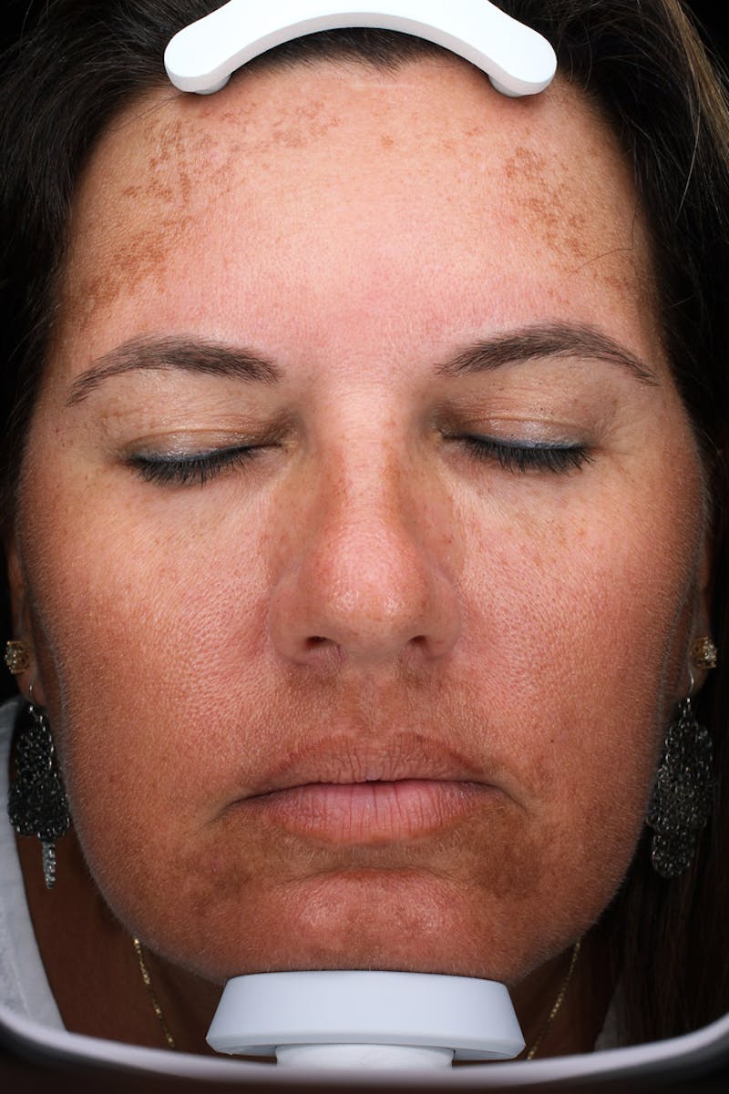 Lasers & Light Before & After Gallery - Patient 363004 - Image 1
