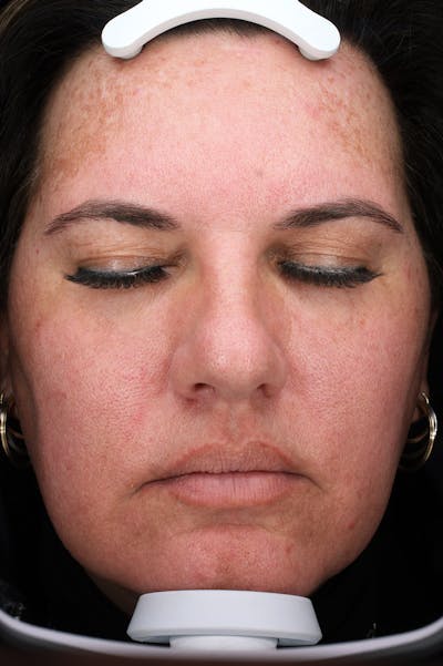 Lasers & Light Before & After Gallery - Patient 363004 - Image 2