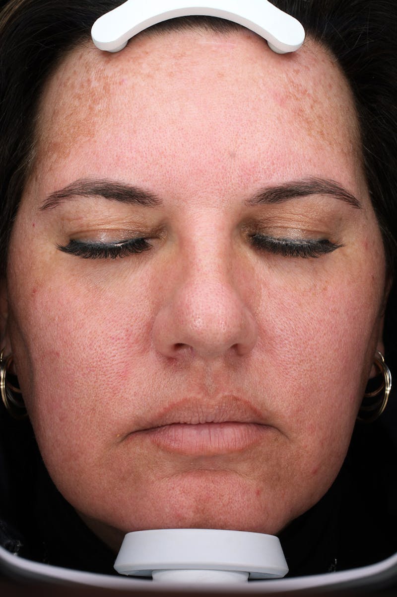 Lasers & Light Before & After Gallery - Patient 363004 - Image 2
