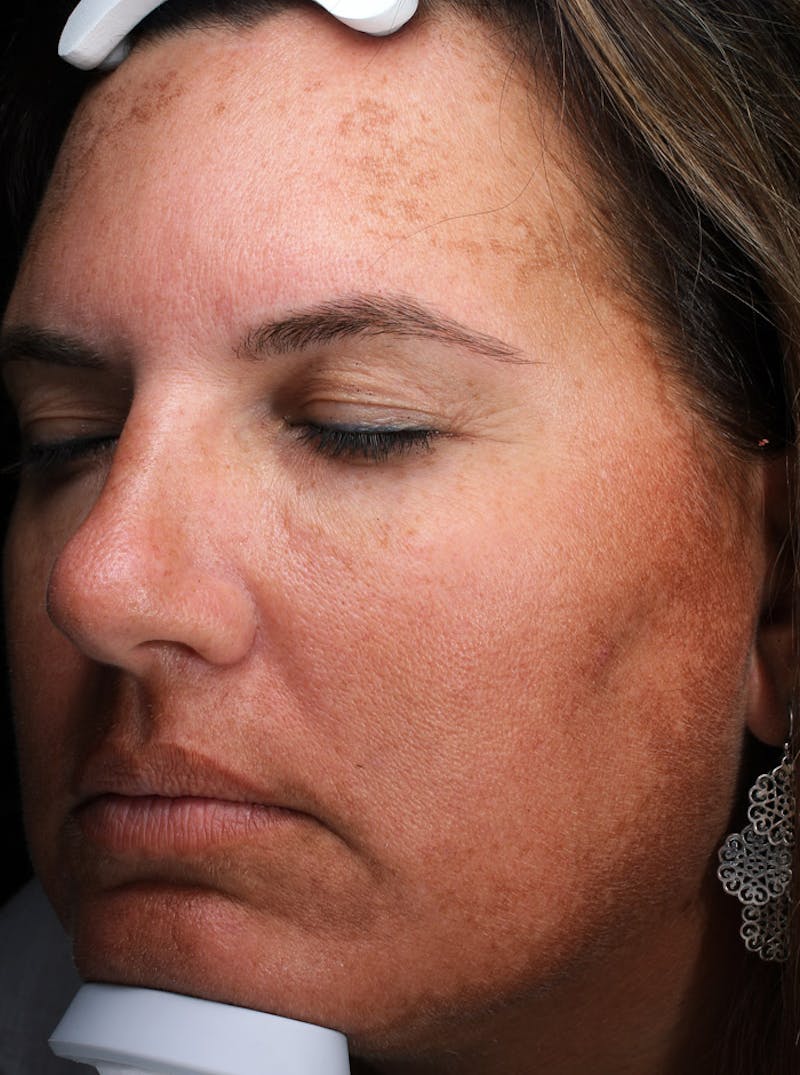 Lasers & Light Before & After Gallery - Patient 363004 - Image 3