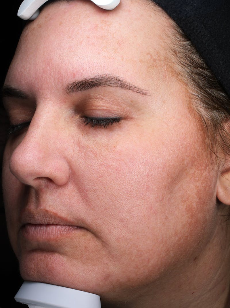 Lasers & Light Before & After Gallery - Patient 363004 - Image 4