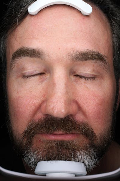 Lasers & Light Before & After Gallery - Patient 837040 - Image 1