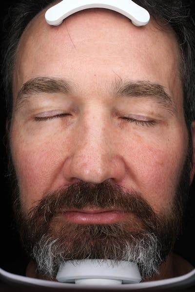 Lasers & Light Before & After Gallery - Patient 837040 - Image 2