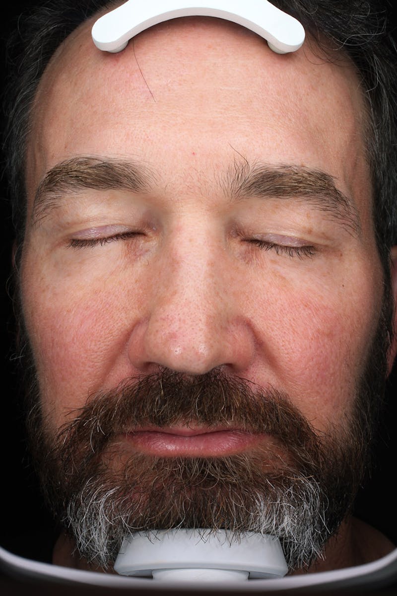 Lasers & Light Before & After Gallery - Patient 837040 - Image 2
