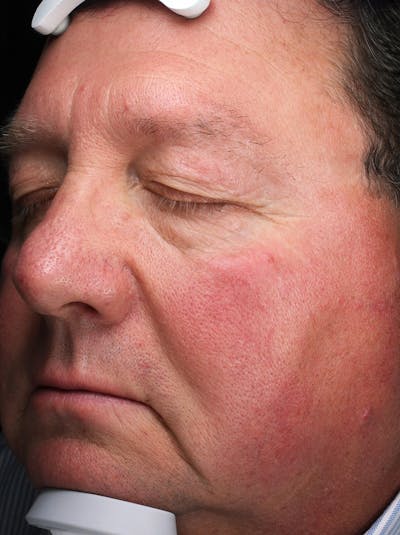 Lasers & Light Before & After Gallery - Patient 248493 - Image 1