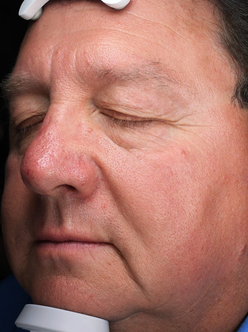 Lasers & Light Before & After Gallery - Patient 248493 - Image 2