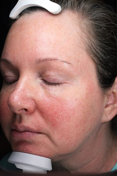 Lasers & Light Before & After Gallery - Patient 677308 - Image 1