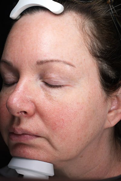 Lasers & Light Before & After Gallery - Patient 677308 - Image 2