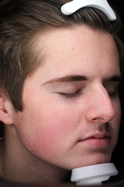 Lasers & Light Before & After Gallery - Patient 269108 - Image 1