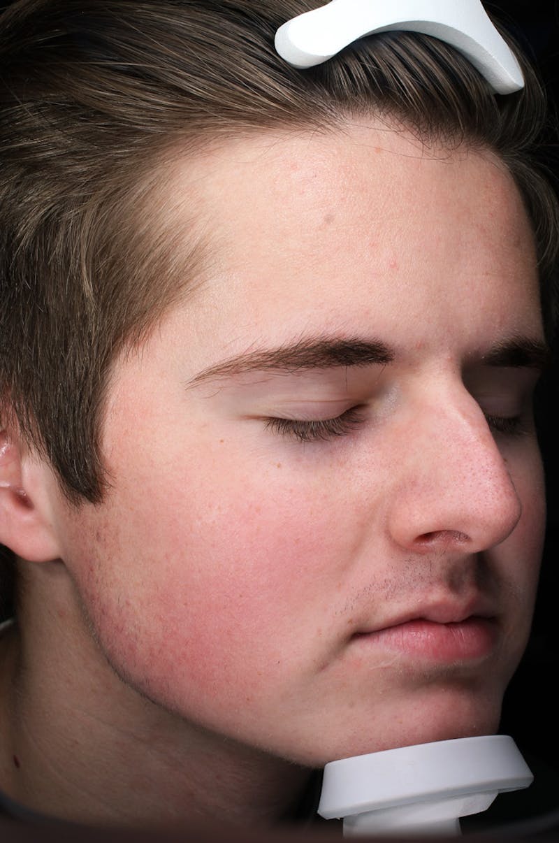 Lasers & Light Before & After Gallery - Patient 269108 - Image 1