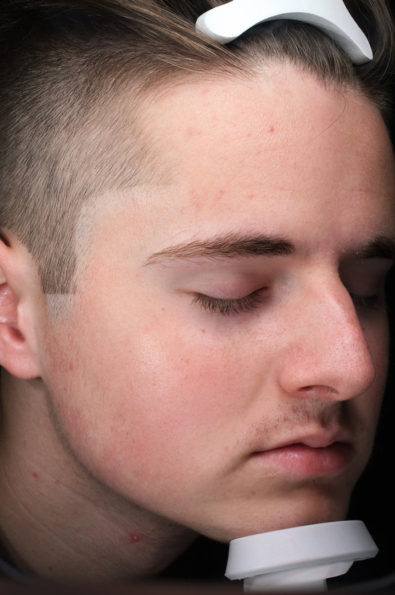 Lasers & Light Before & After Gallery - Patient 269108 - Image 2