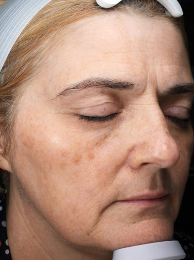 Lasers & Light Before & After Gallery - Patient 225252 - Image 1