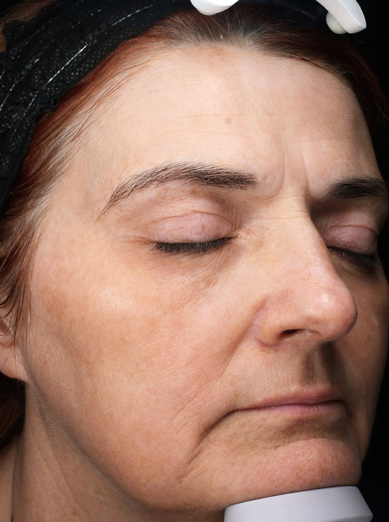 Lasers & Light Before & After Gallery - Patient 225252 - Image 2