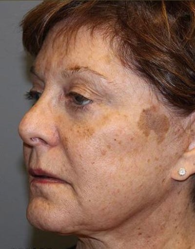 Lasers & Light Before & After Gallery - Patient 161172 - Image 1