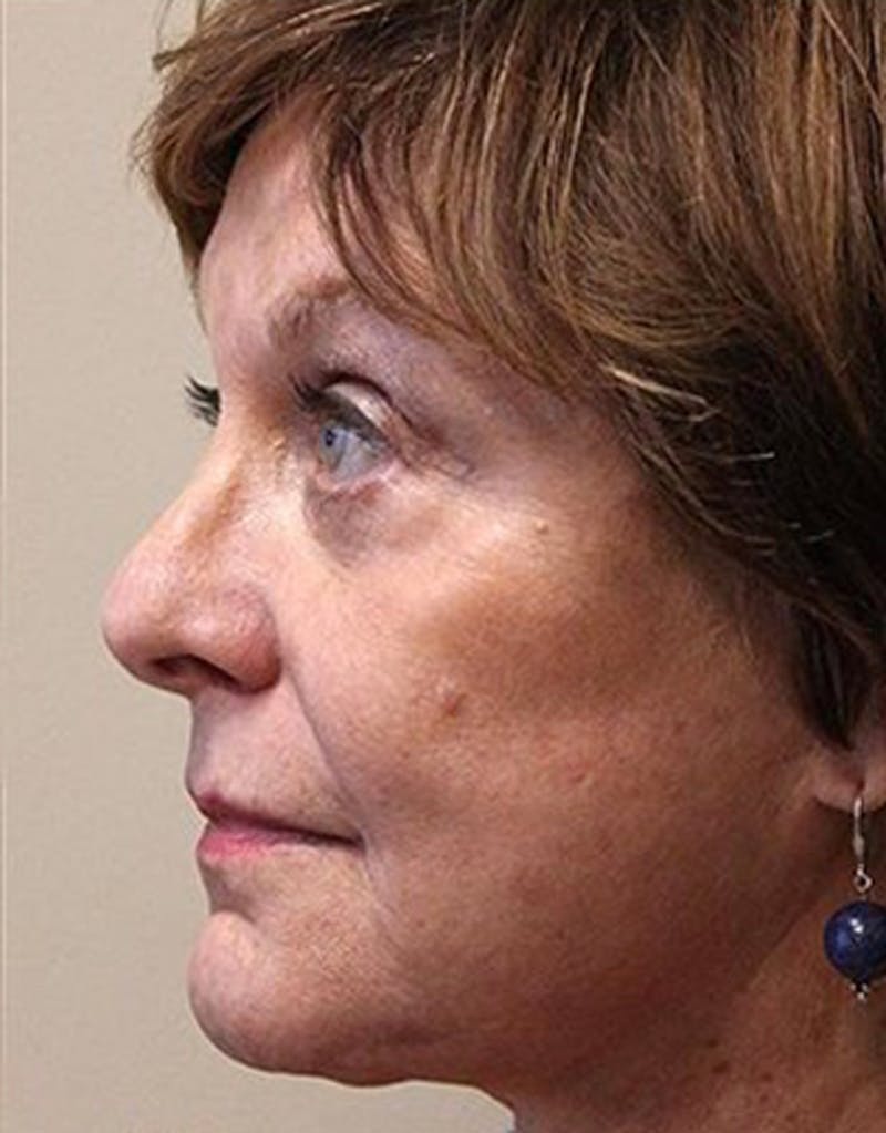 Lasers & Light Before & After Gallery - Patient 161172 - Image 2