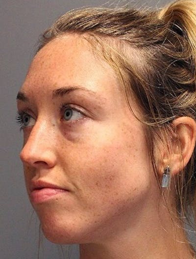 Lasers & Light Before & After Gallery - Patient 140427 - Image 1