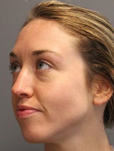Lasers & Light Before & After Gallery - Patient 140427 - Image 2