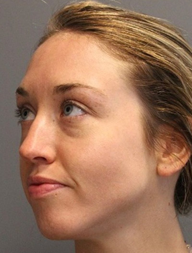 Lasers & Light Before & After Gallery - Patient 140427 - Image 2