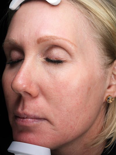 Lasers & Light Before & After Gallery - Patient 196735 - Image 1