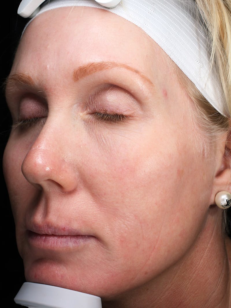 Lasers & Light Before & After Gallery - Patient 196735 - Image 2