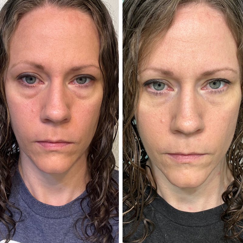 Blepharoplasty Before & After Gallery - Patient 343617 - Image 1