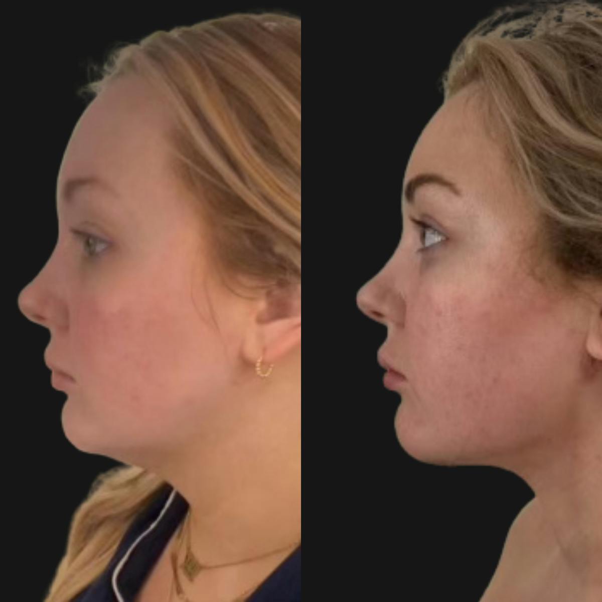 Chin Augmentation Before & After Gallery - Patient 314081 - Image 2