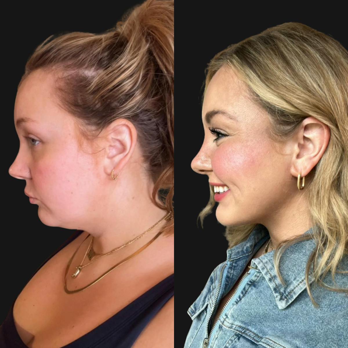 Chin Augmentation Before & After Gallery - Patient 314081 - Image 1