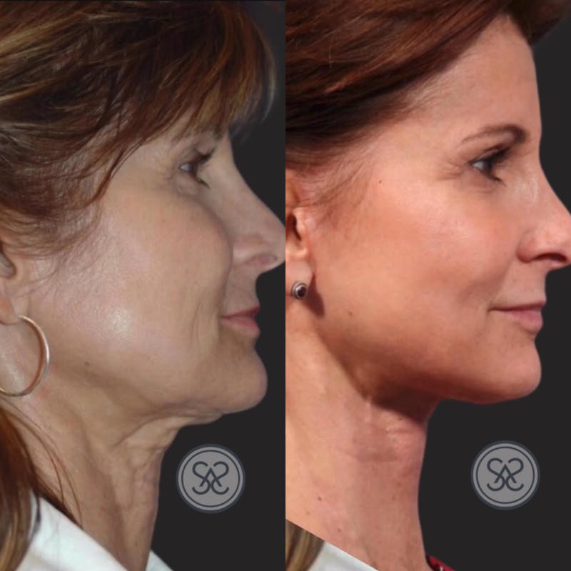 Neck Lift Before & After Gallery - Patient 287643 - Image 1