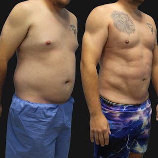 High Definition Men Before & After Gallery - Patient 607758 - Image 2