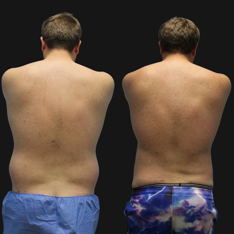 High Definition Men Before & After Gallery - Patient 607758 - Image 5