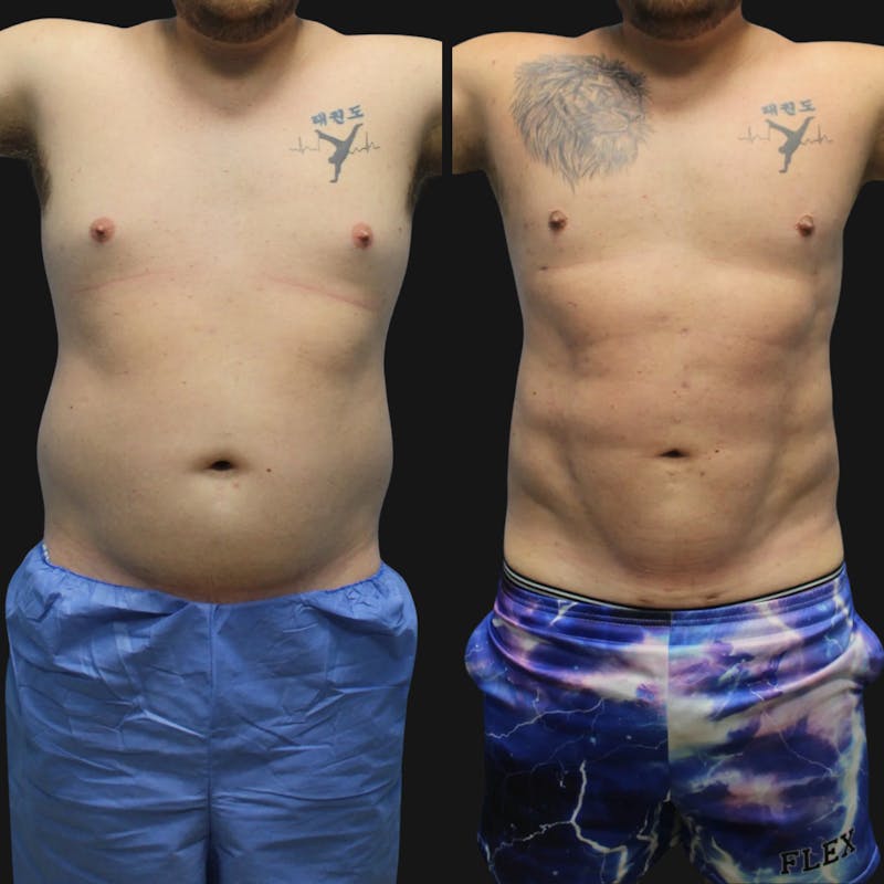 High Definition Men Before & After Gallery - Patient 607758 - Image 1