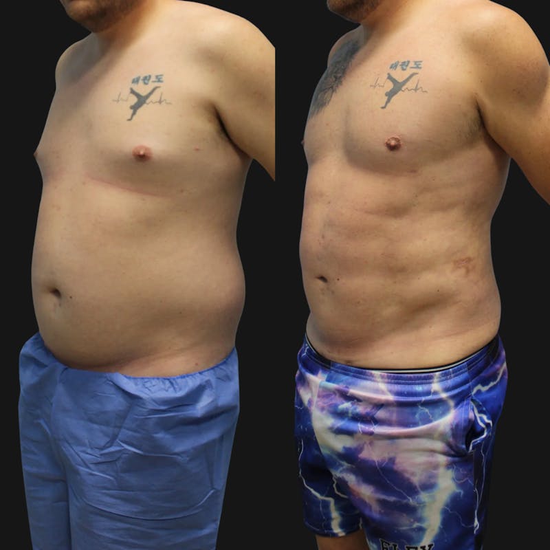 High Definition Men Before & After Gallery - Patient 607758 - Image 3