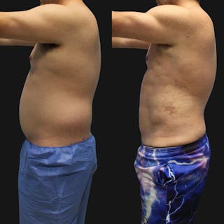 High Definition Men Before & After Gallery - Patient 607758 - Image 4