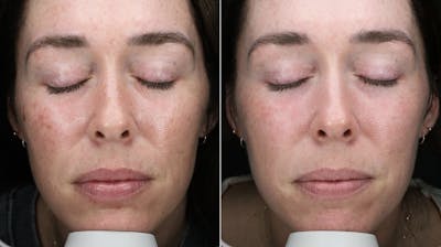 Lasers & Light Before & After Gallery - Patient 158246 - Image 1