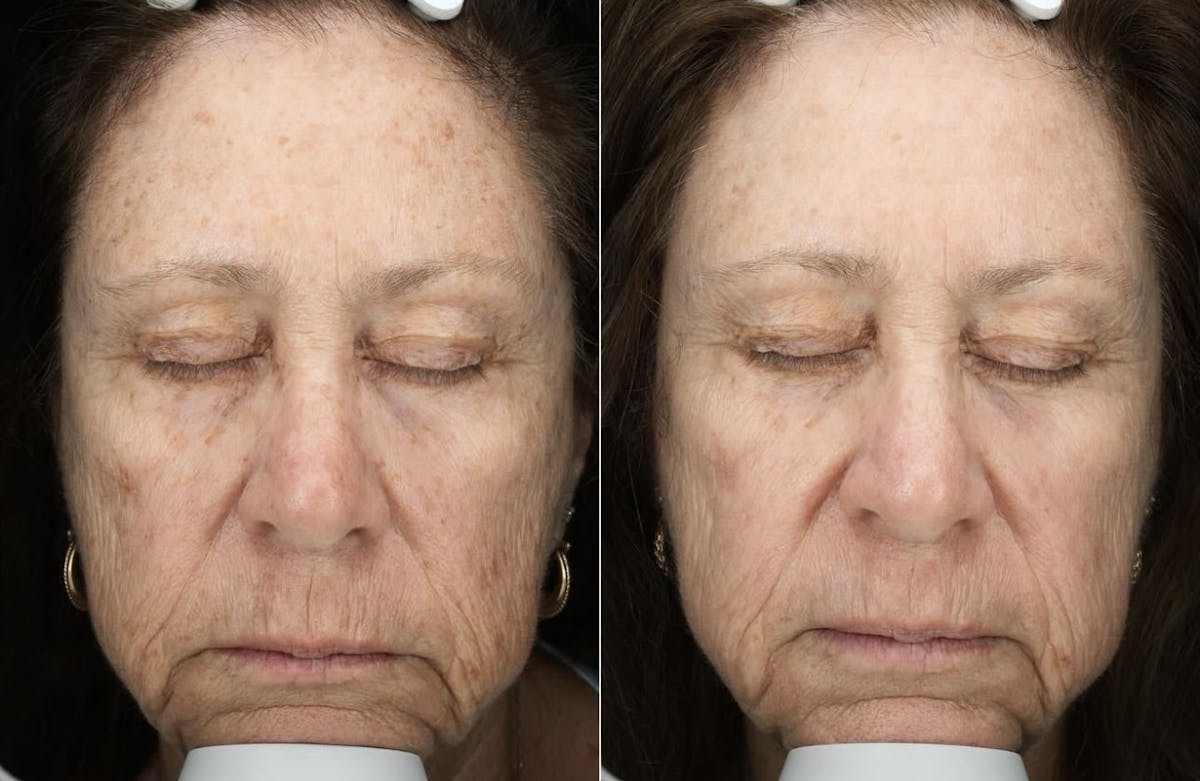 Lasers & Light Before & After Gallery - Patient 438521 - Image 1