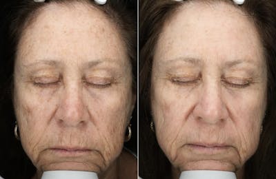 Lasers & Light Before & After Gallery - Patient 438521 - Image 1