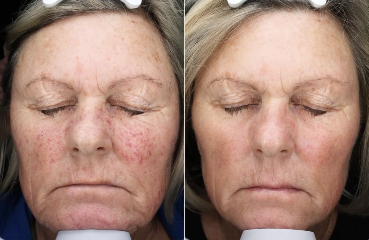 Lasers & Light Before & After Gallery - Patient 401132 - Image 1