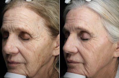 Lasers & Light Before & After Gallery - Patient 403228 - Image 1