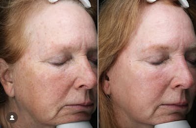 Lasers & Light Before & After Gallery - Patient 204563 - Image 1